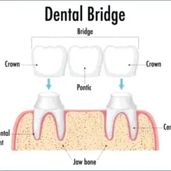 The Role of Dental Bridges in Restoring Your Smile