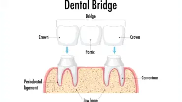 dental bridges